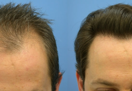 Hair transplantation in Turkey Hair transplantation in Turkey